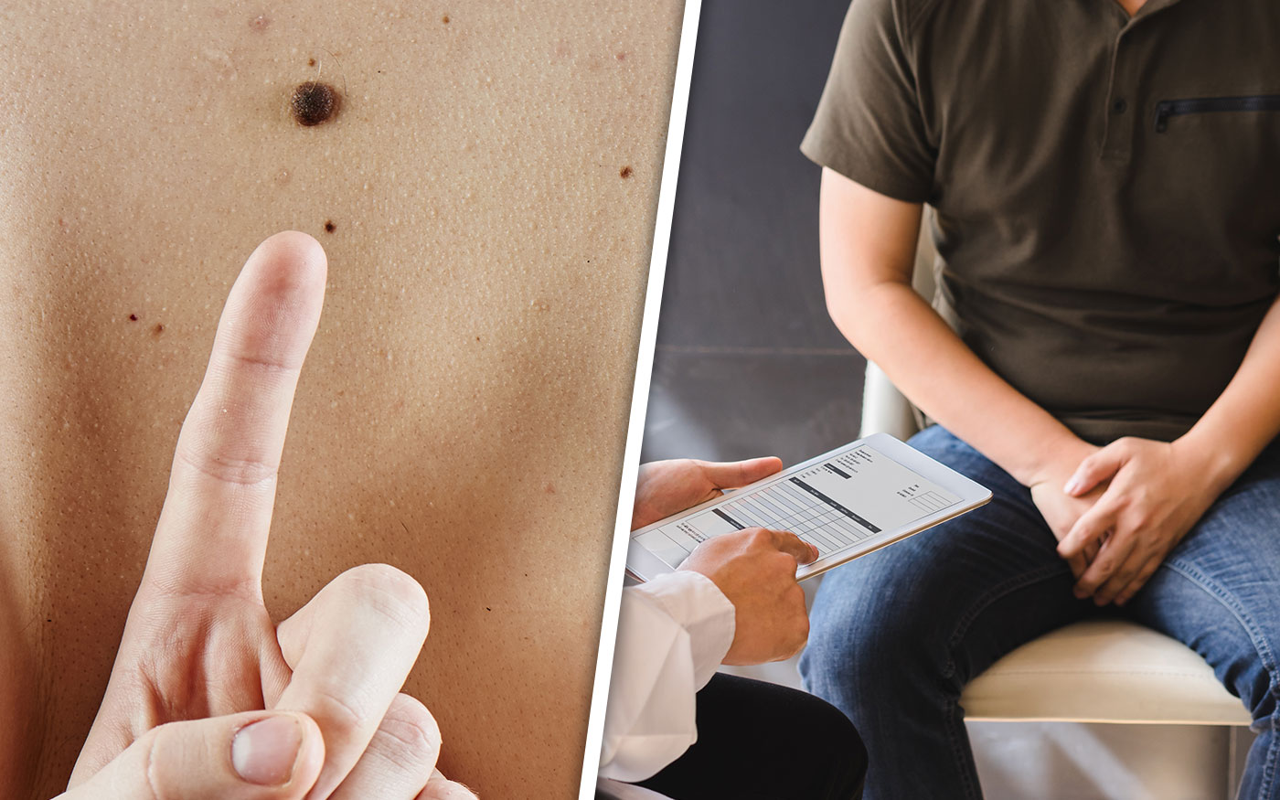 szurovizsgalatok_prosztata_anyajegy_freepik_20210922